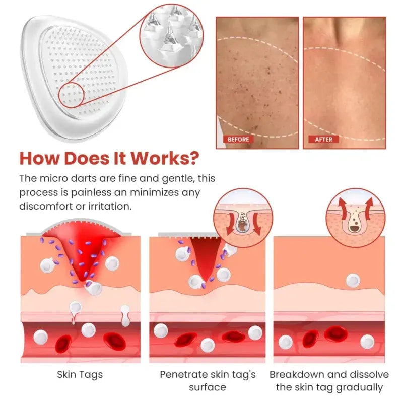 Derma Smooth Skin Tag Removal Patch ✨