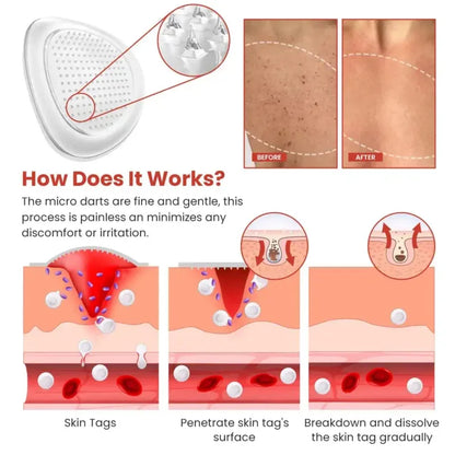 Derma Smooth Skin Tag Removal Patch 🌟